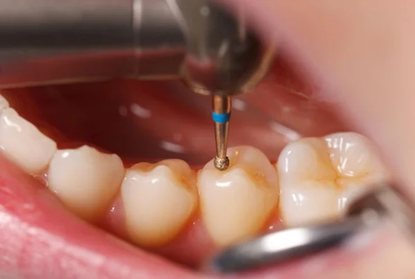 Dental Fillings or Restorative Dentistry